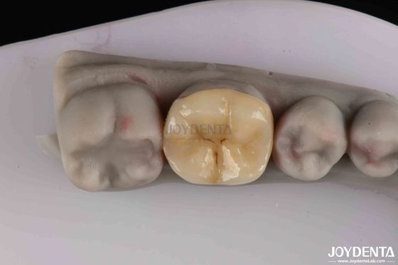 Aanpasbare Zirconia Inlay Onlay Minimale voorbereiding voor herstel van beschadigde tanden