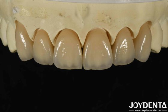 Uitstekende biocompatibiliteit gelaagd zircone met een hoge esthetiek en dichtheid 6,0-6,1 G/cm3