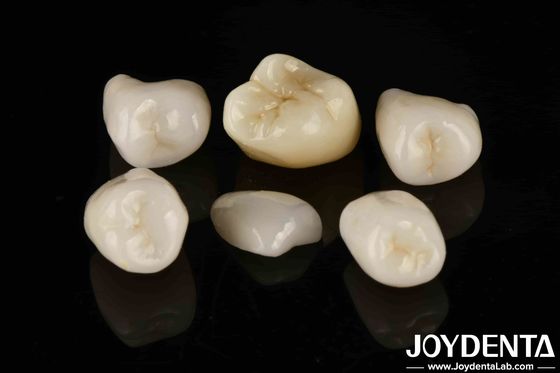 Gemakkelijk cementeren Emax Inlay Onlay Middelstand Natuurlijke esthetiek