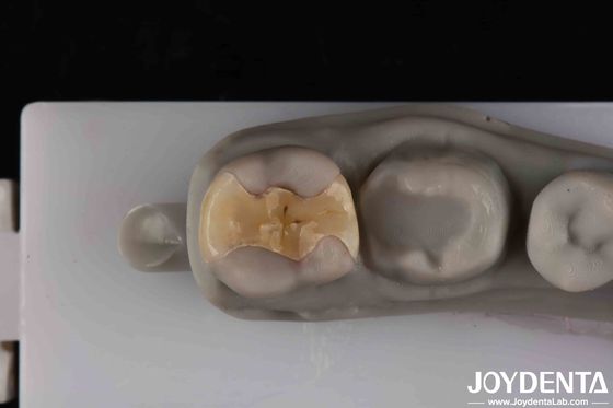 Beveiligde cementatie met een laag doorzichtigheidsniveau voor duurzame en esthetische restauratie