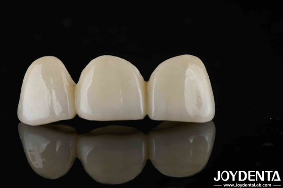 Natuurlijke stijl met lagen vol zirconia hoge doorschijnendheid en esthetiek