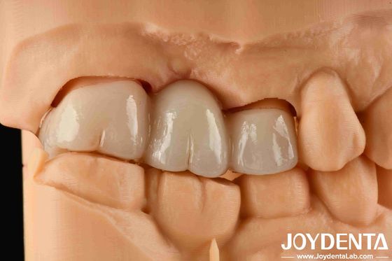 Ervaring Kleur Realistisch Volledig Zirconia Met Hoge weerstand Tegen Vlekken En Buigsterkte Van 1000 MPa