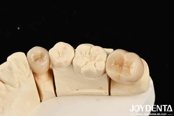 Uitstekende biocompatibiliteit Volledig zirconia met hoge weerstand tegen corrosie en buigsterkte van 1000 MPa