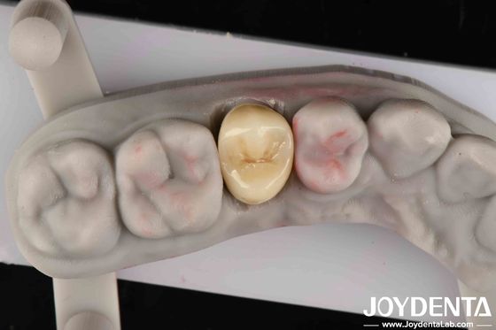 Breuksterkte 9 MPa·m1/2 Hoge esthetiek Hoge slijtvastheid Volledig Zirconia