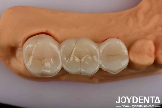 Hoge sterkte tandheelkundige Zirconia uw ultieme oplossing voor een natuurlijke esthetiek
