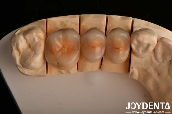Hoge slijtvastheid en natuurlijke esthetiek met meerlagige volledige zirconia technologie