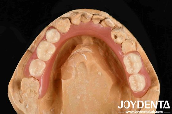 Gepersonaliseerde aanpassing Acrylische prothese Finish goede elasticiteit en lichtgewicht eigenschappen voor verbeterde prothese prestaties