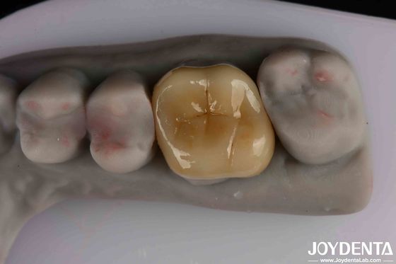 Gemakkelijk schoon te maken en duurzaam Emax Inlay Onlay Resistentie tegen kleuring voor optimale prestaties
