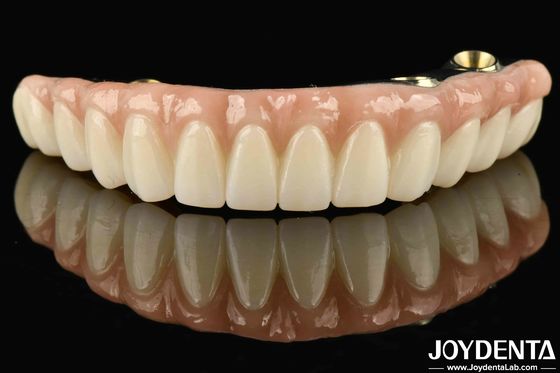 Ti-Bar Zirconia Hybride Bridge Compatibel met natuurlijke tanden en tandvlees Autobiografie Herstel van kauwfunctie