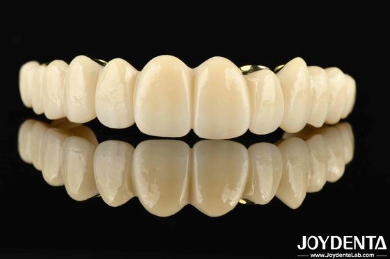 Op maat gemaakte Ti-Bar Zirconia Hybride brug De perfecte combinatie voor comfort en functionaliteit