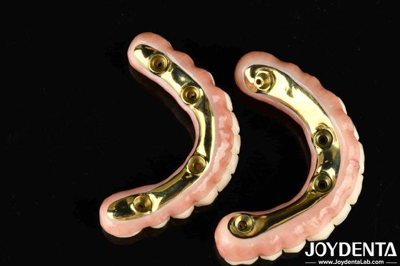 Natuurlijk uitziende esthetiek Zirconia hybride brug met hoge duurzaamheid en biocompatibiliteit Ti-Bar Zirconia hybride brug