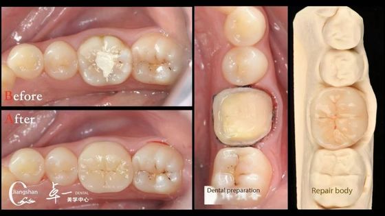 Biocompatibiliteit en hoge compatibiliteit met natuurlijke tanden Restoratie Tandheelkundige inleg Restoratieve