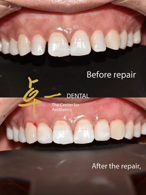 Zeg hallo tegen een vlekkeloze glimlach met cosmetische veneers geen verkleuring geen voorbereiding