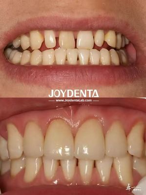 Langdurige tandheelkundige veneers zonder verkleuring Perfect voor B2B-aankoopbehoeften en meer