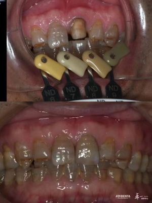 Translucentie Zirconia kronen Meerlaagse gradiënttechnologie voor optimale translucentie en langdurige biocompatibiliteit