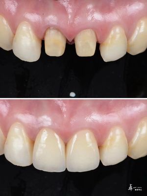 Verniers gemaakt met zeer breukbestendig tandheelkundig zirconia en meerlagige hellingstechnologie