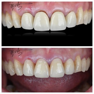 Comfortabele Zirconia-tandbruggen Lichte natuurlijke kleurovergangen voor een optimale patiëntbeleving