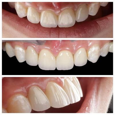 Aanwijzingen voor de voortand Tandplaatjes met een dikte van 0,5 mm en een perfecte doorlaatbaarheid