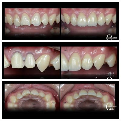 Natuurlijke veneers voor een natuurlijke en mooie glimlach
