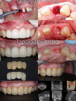 Meerschaalige hellingtechnologie Tandheelkundige zirconia veilig en esthetisch aangenaam op de lange termijn