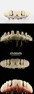 Tandheelkundige esthetiek Titanium Malong Hybrid Bridge Ultieme oplossing voor tandheelkundige restauratie