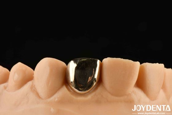 Ervaar orale revalidatie als nooit tevoren met Gold Crown Wax Casting