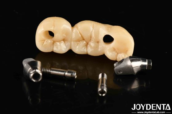 Sterke Implantatie Kroon En Brug Perfecte oplossing voor een esthetisch aangename esthetiek