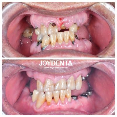 Tandkronen van zirconia duurzaam en geschikt voor achter- en voorrestoraties