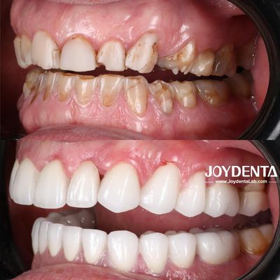 Premium Zirkonium Tandkroon Oplossingen | JOY Dental Lab