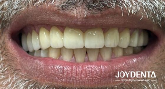 Zirkoniumprothesen die natuurlijke tanden nabootsen