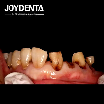 Premium Zirconia kronen voor Global Dental Labs.