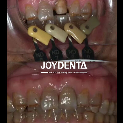 Translucide zirconia kronen