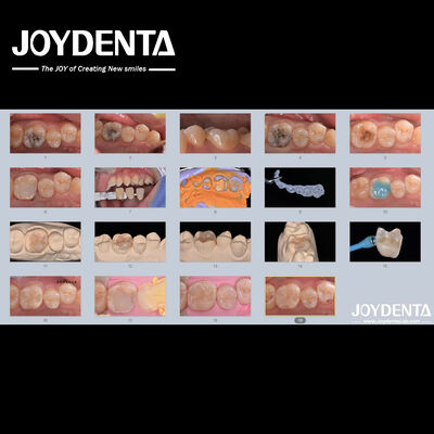 Volwassenen Kinderen Porseleinen keramische tandheelkundige inleg Restoratief voor beschadigde tanden