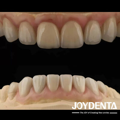 Hoogtranslucentie Emax Cosmetische tandheelkunde Veneers Hoog esthetisch Ultra dun