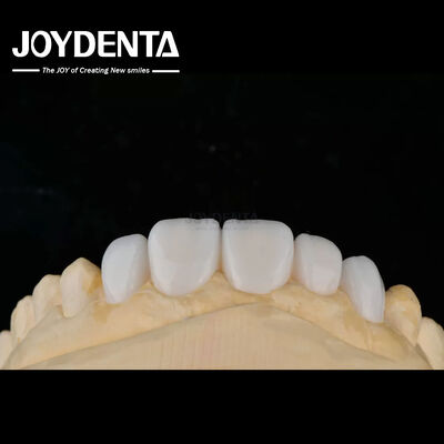 Aanpassing Porselein Materiaal Emax Tanden veneers voor hoge esthetiek binding